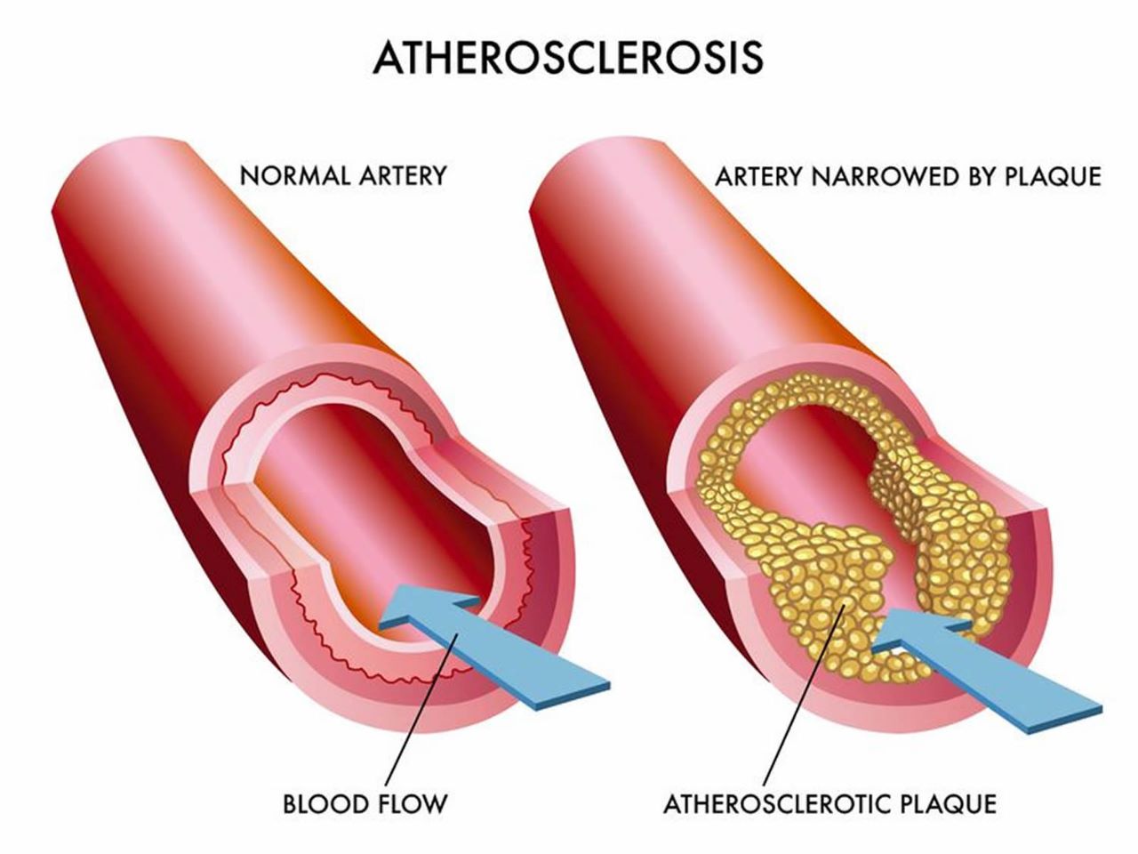 Atherosclerosis 